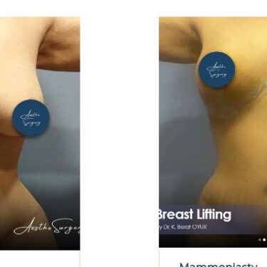 Подтяжка груди