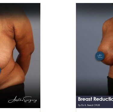 Breast Reduction