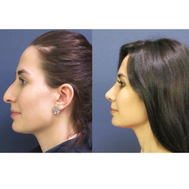 Ринопластика