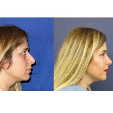 Ринопластика