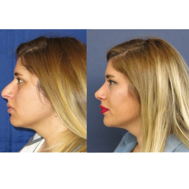 Ринопластика