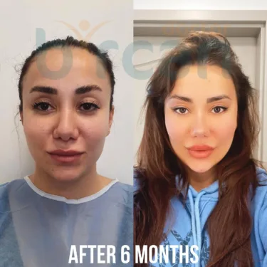 Пересадка волос