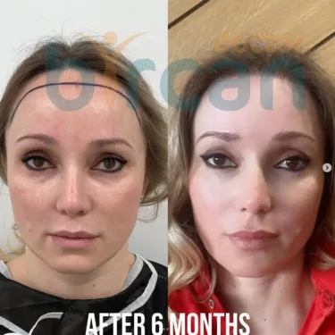 Пересадка волос