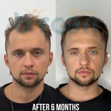 Пересадка волос