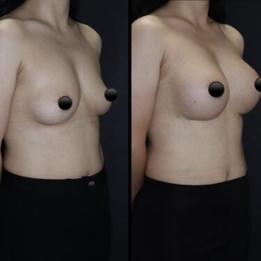 Увеличение груди