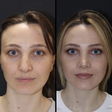 Rhinoplastie 