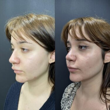 Rhinoplastie 