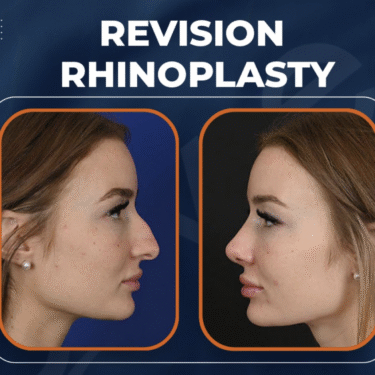 Revision rhinoplasty