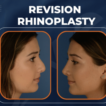 Revision rhinoplasty