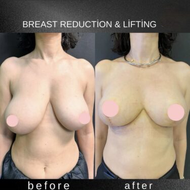 Breast Reduction