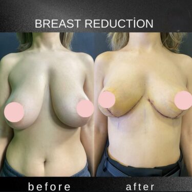 Breast Reduction