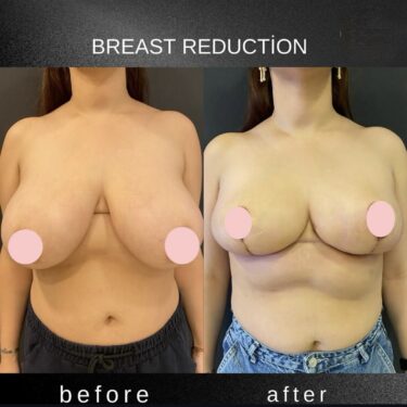 Breast Reduction