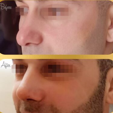 Ринопластика