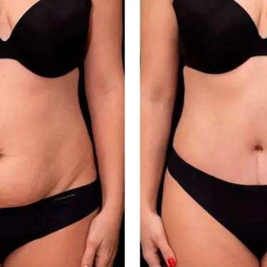 Липосакция