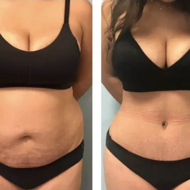 Липосакция