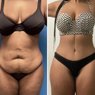 Липосакция