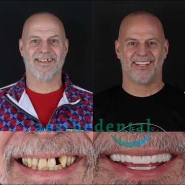 Dental implants