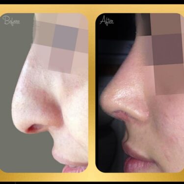 Ринопластика