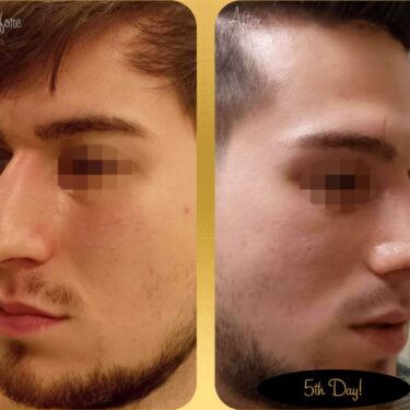 Ринопластика