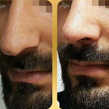 Ринопластика