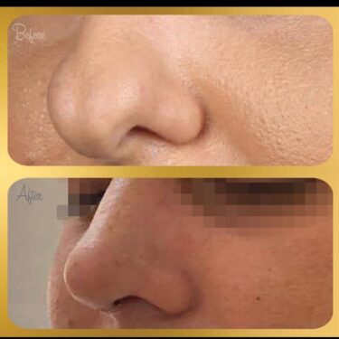 Ринопластика