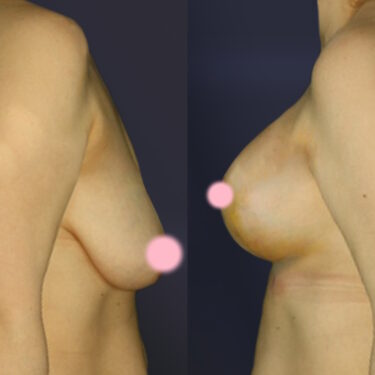Breast Lift with Augmentation