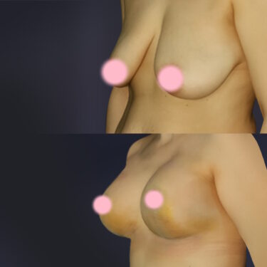 Breast Lift with Augmentation