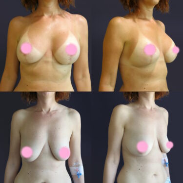 Breast Lift