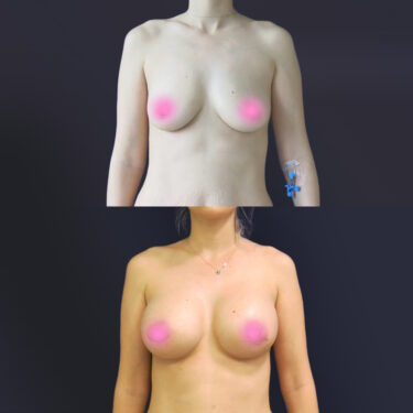 Увеличение груди