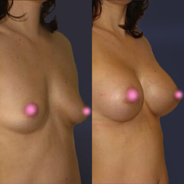 Увеличение груди