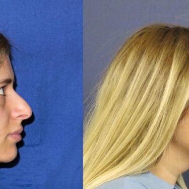 Rhinoplasty 