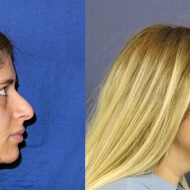 Ринопластика