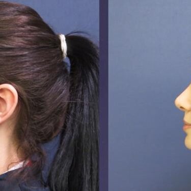 Rhinoplasty 