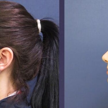 Rhinoplasty