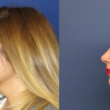 Rhinoplasty 