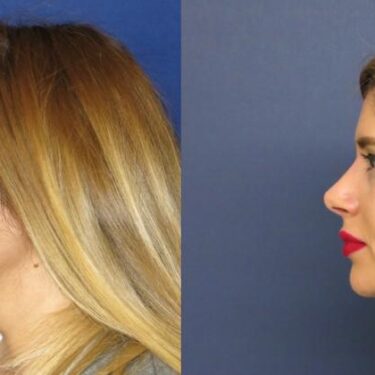 Rhinoplasty