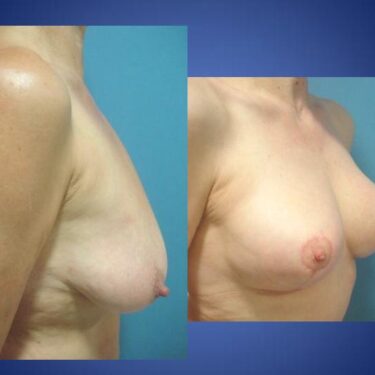 Подтяжка груди