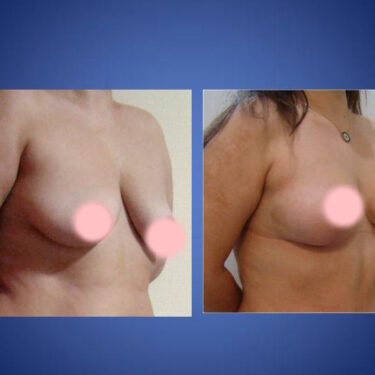 Breast Lift