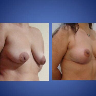 Подтяжка груди