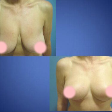 Breast Lift