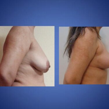 Подтяжка груди