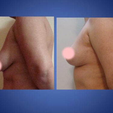 Breast Lift