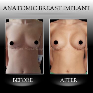 Увеличение груди с помощью анатомических грудных имплантатов