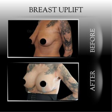 Breast Lift