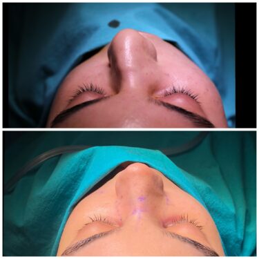 Септопластика