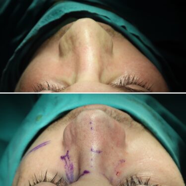 Септопластика