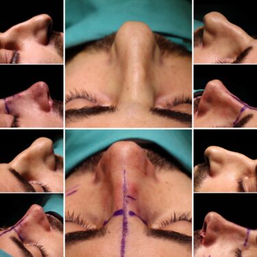 Септопластика