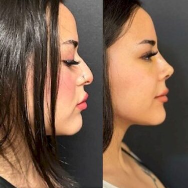 Rhinoplasty