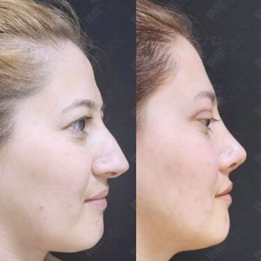 Rhinoplasty