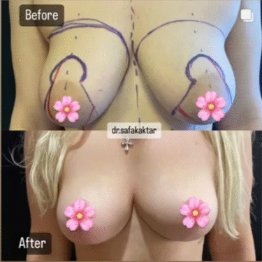 Увеличение груди